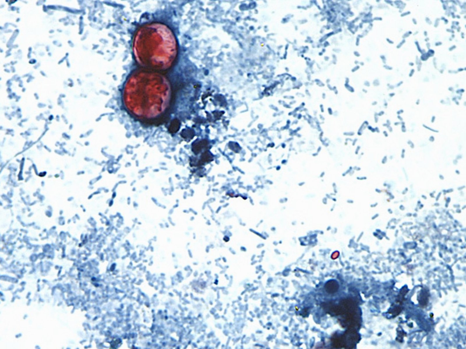 US announces first two deaths from cyclospora outbreak