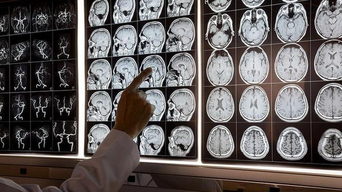What is brain fog and when does it need investigation